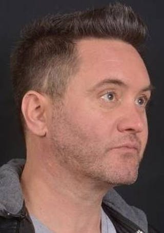 FaceTite Before & After Gallery - Patient 380864 - Image 10