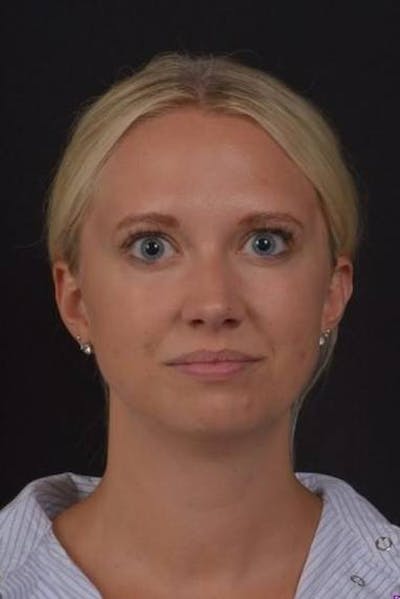 FaceTite Before & After Gallery - Patient 101371 - Image 1