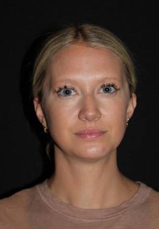 FaceTite Before & After Gallery - Patient 101371 - Image 2