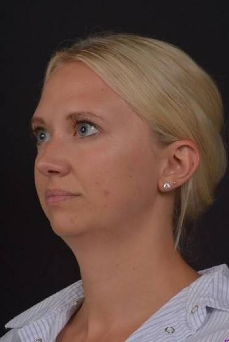 FaceTite Before & After Gallery - Patient 101371 - Image 3