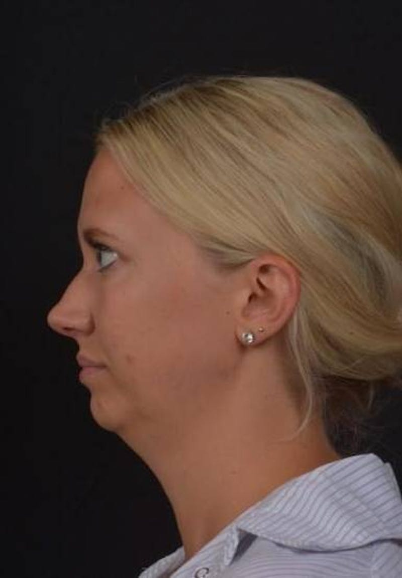 FaceTite Before & After Gallery - Patient 101371 - Image 5