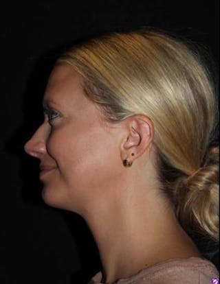 FaceTite Before & After Gallery - Patient 101371 - Image 6