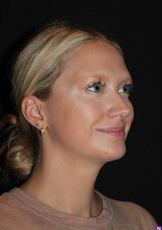 FaceTite Before & After Gallery - Patient 101371 - Image 8