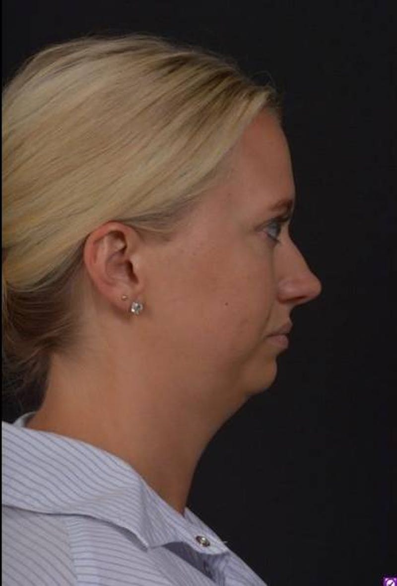 FaceTite Before & After Gallery - Patient 101371 - Image 9