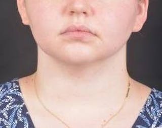 FaceTite Before & After Gallery - Patient 344989 - Image 2