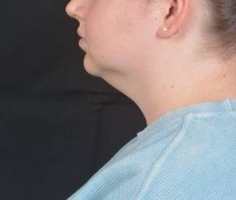 FaceTite Before & After Gallery - Patient 344989 - Image 3