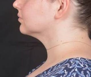 FaceTite Before & After Gallery - Patient 344989 - Image 4