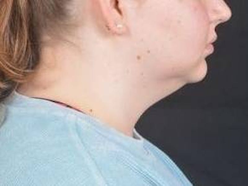 FaceTite Before & After Gallery - Patient 344989 - Image 5