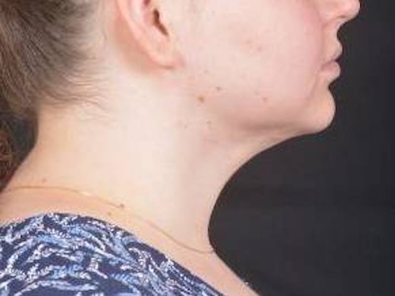 FaceTite Before & After Gallery - Patient 344989 - Image 6