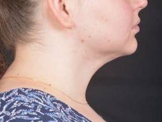 FaceTite Before & After Gallery - Patient 344989 - Image 6