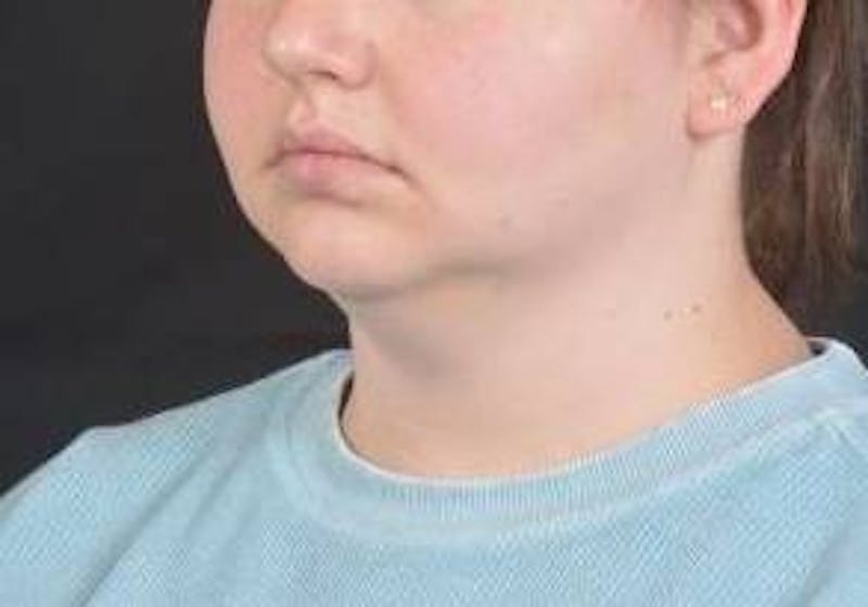 FaceTite Before & After Gallery - Patient 344989 - Image 7