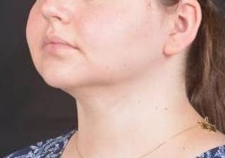 FaceTite Before & After Gallery - Patient 344989 - Image 8