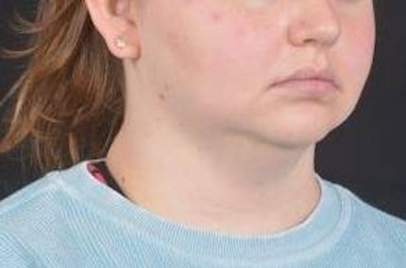 FaceTite Before & After Gallery - Patient 344989 - Image 9