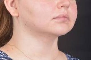 FaceTite Before & After Gallery - Patient 344989 - Image 10