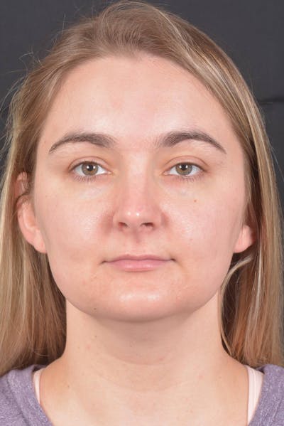 FaceTite Before & After Gallery - Patient 825707 - Image 1