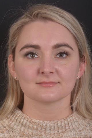 FaceTite Before & After Gallery - Patient 825707 - Image 2