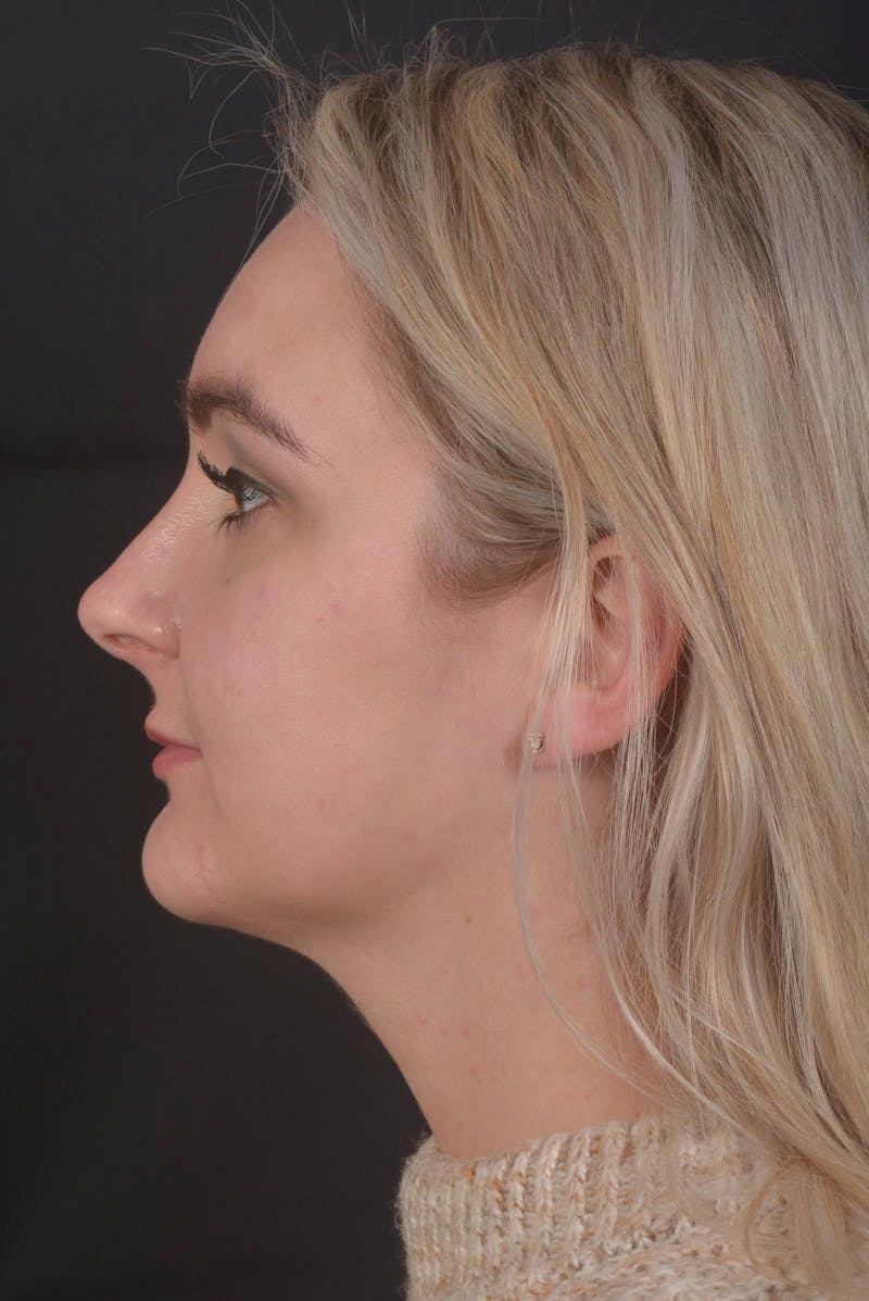 FaceTite Before & After Gallery - Patient 825707 - Image 4