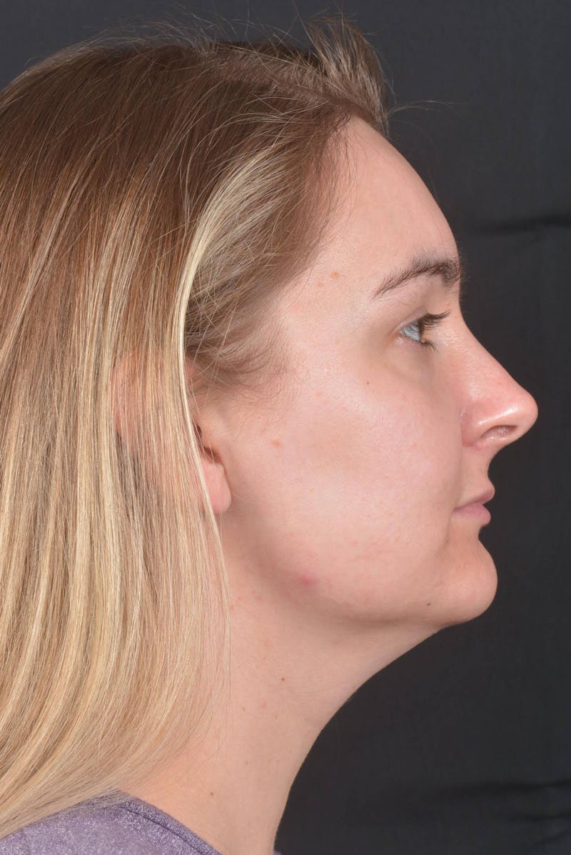 FaceTite Before & After Gallery - Patient 825707 - Image 5