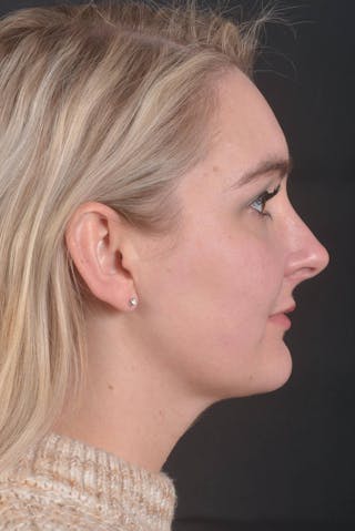 FaceTite Before & After Gallery - Patient 825707 - Image 6