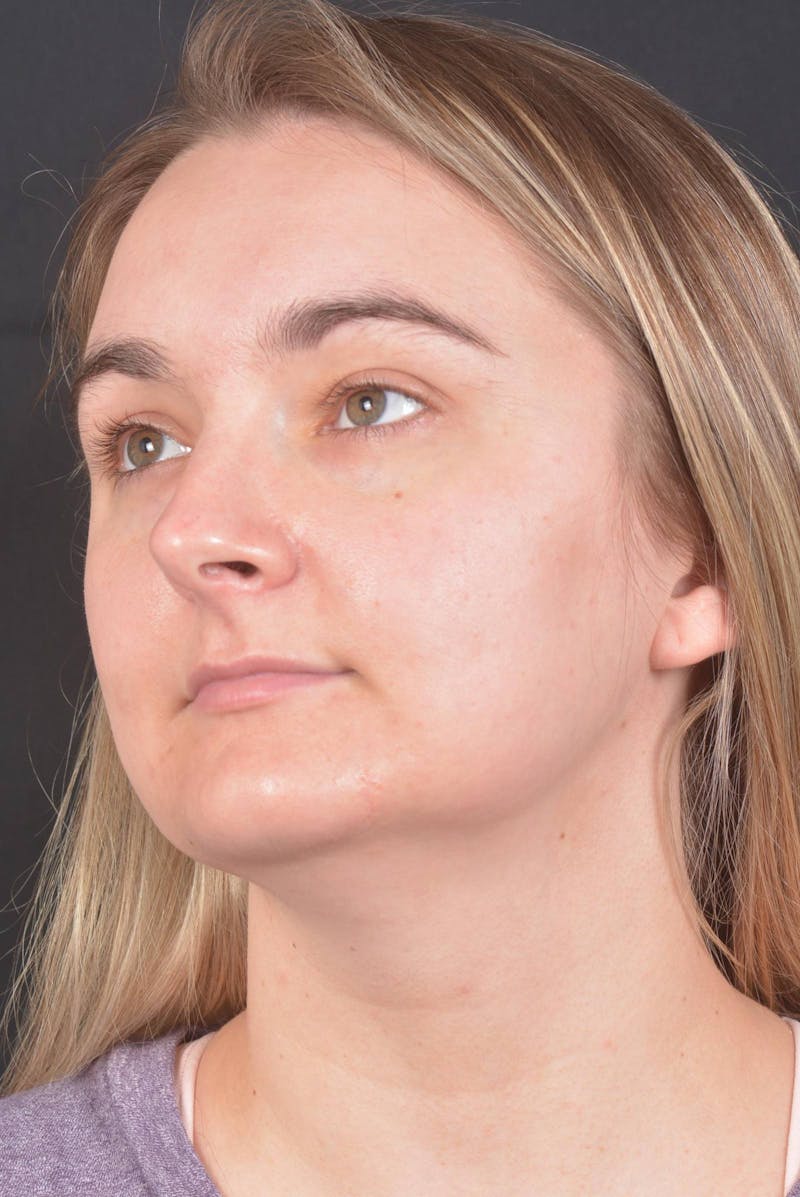 FaceTite Before & After Gallery - Patient 825707 - Image 7