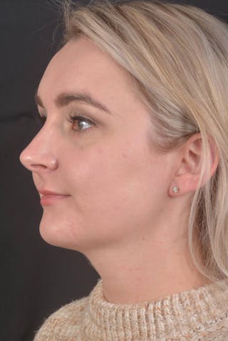 FaceTite Before & After Gallery - Patient 825707 - Image 8