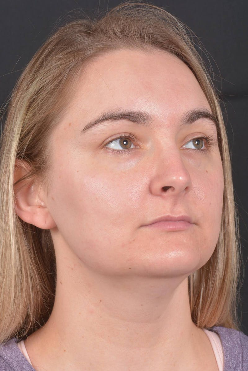 FaceTite Before & After Gallery - Patient 825707 - Image 9