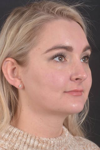 FaceTite Before & After Gallery - Patient 825707 - Image 10