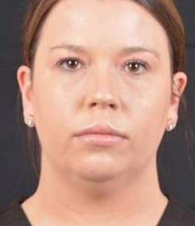 FaceTite Before & After Gallery - Patient 151843 - Image 1