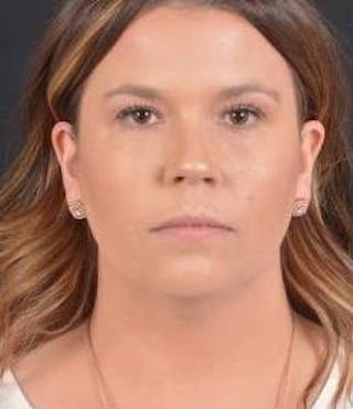 FaceTite Before & After Gallery - Patient 151843 - Image 2