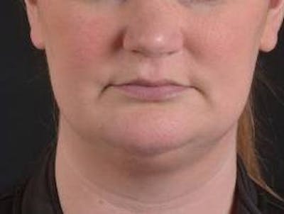 FaceTite Before & After Gallery - Patient 205652 - Image 1