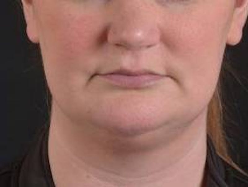 FaceTite Before & After Gallery - Patient 205652 - Image 1