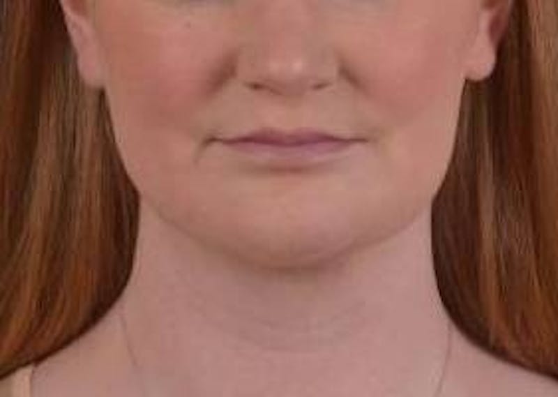 FaceTite Before & After Gallery - Patient 205652 - Image 2