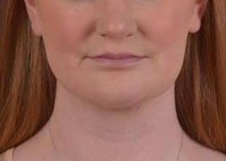 FaceTite Before & After Gallery - Patient 205652 - Image 2