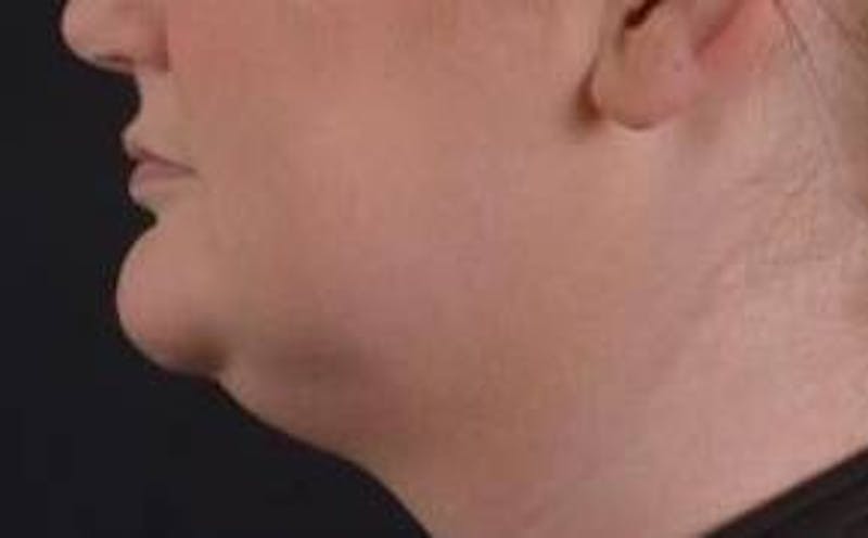 FaceTite Before & After Gallery - Patient 205652 - Image 3
