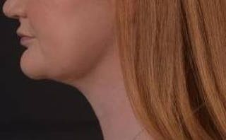 FaceTite Before & After Gallery - Patient 205652 - Image 4