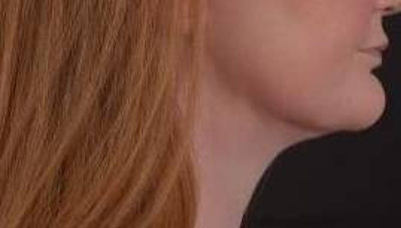FaceTite Before & After Gallery - Patient 205652 - Image 6