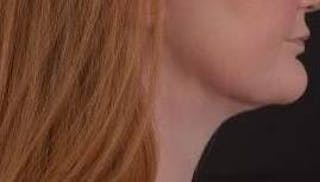 FaceTite Before & After Gallery - Patient 205652 - Image 6