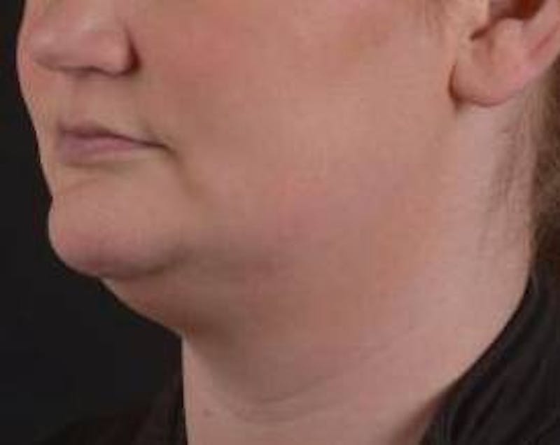 FaceTite Before & After Gallery - Patient 205652 - Image 7