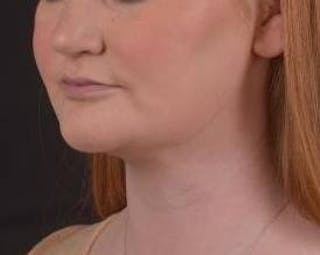 FaceTite Before & After Gallery - Patient 205652 - Image 8