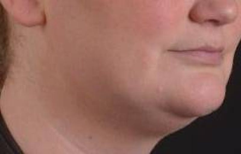 FaceTite Before & After Gallery - Patient 205652 - Image 9