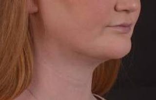 FaceTite Before & After Gallery - Patient 205652 - Image 10