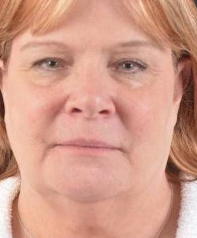 FaceTite Before & After Gallery - Patient 350944 - Image 1