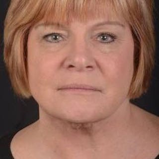 FaceTite Before & After Gallery - Patient 350944 - Image 2