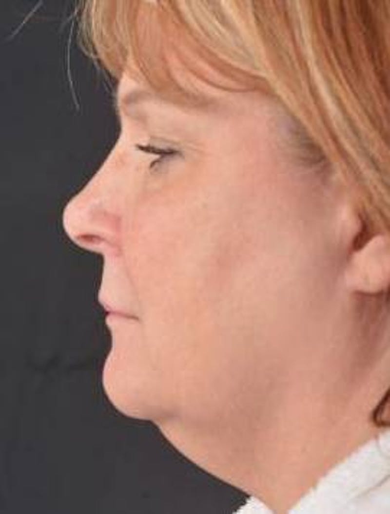 FaceTite Before & After Gallery - Patient 350944 - Image 3
