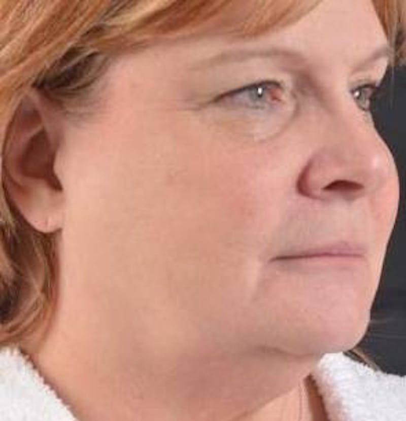 FaceTite Before & After Gallery - Patient 350944 - Image 7