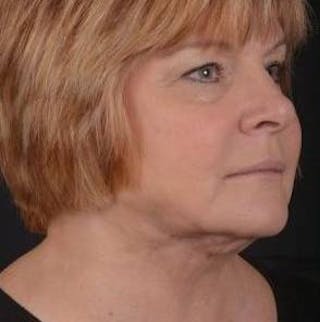 FaceTite Before & After Gallery - Patient 350944 - Image 8