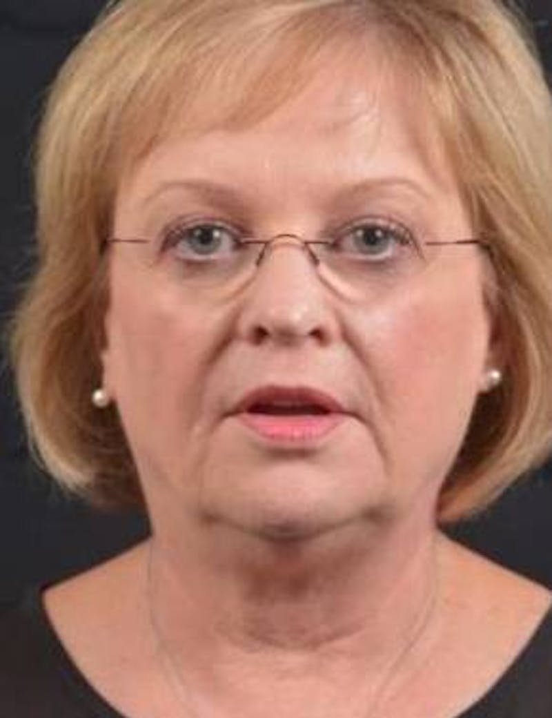 FaceTite Before & After Gallery - Patient 254194 - Image 1