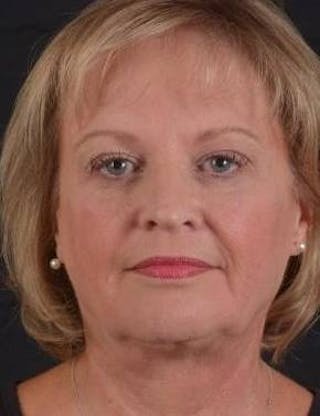 FaceTite Before & After Gallery - Patient 254194 - Image 2