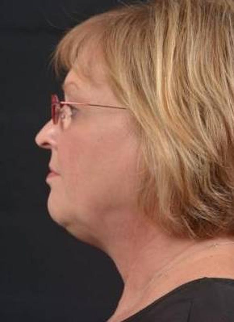 FaceTite Before & After Gallery - Patient 254194 - Image 3