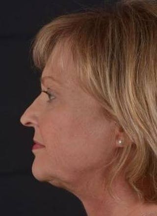 FaceTite Before & After Gallery - Patient 254194 - Image 4